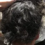 After PRP treatment: thick regrown black curly hair following alopecia recovery