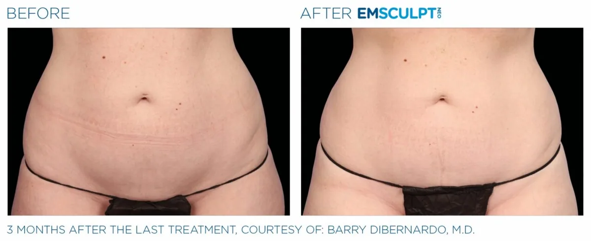 EMSCULPT NEO before and after, female abdomen front view
