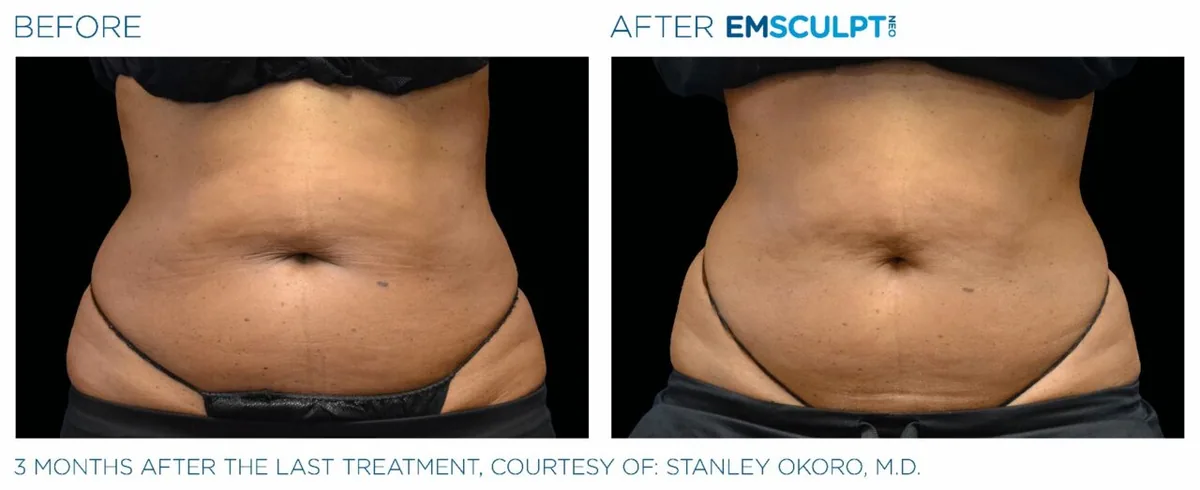 EMSCULPT NEO before and after, female abdomen front view (second patient)