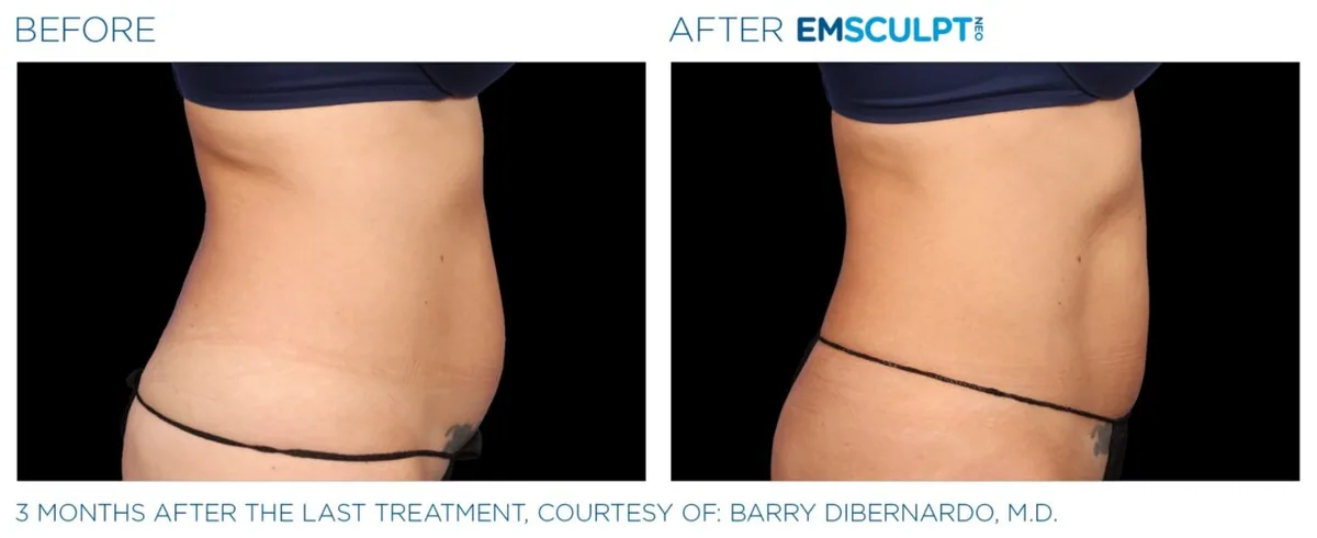 EMSCULPT NEO before and after, female abdomen lateral view