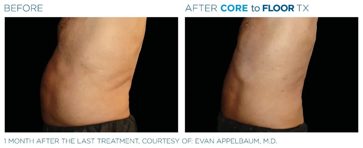 EMSCULPT NEO before and after, male abdomen lateral view
