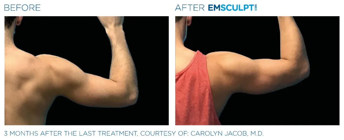 EMSCULPT NEO before and after, male biceps