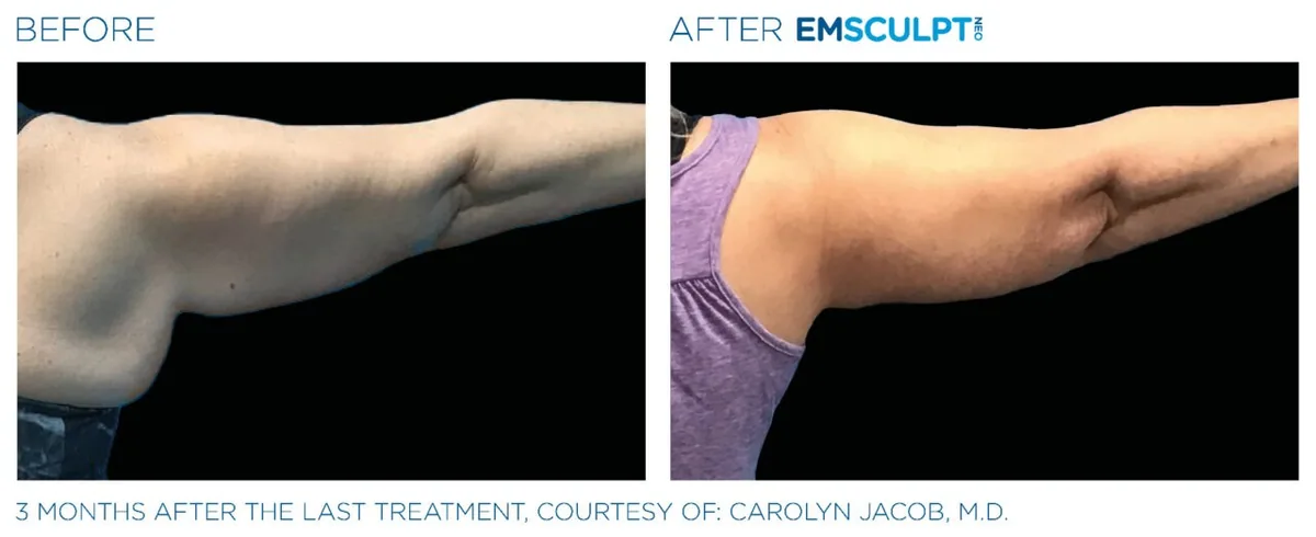 EMSCULPT NEO before and after, female triceps