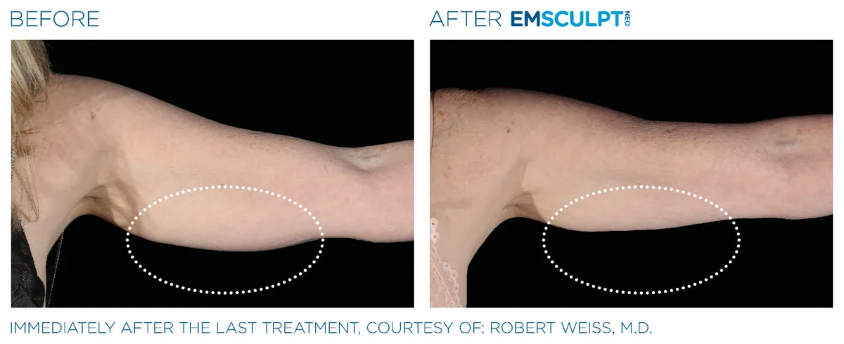 EMSCULPT NEO before and after, female triceps (second patient)