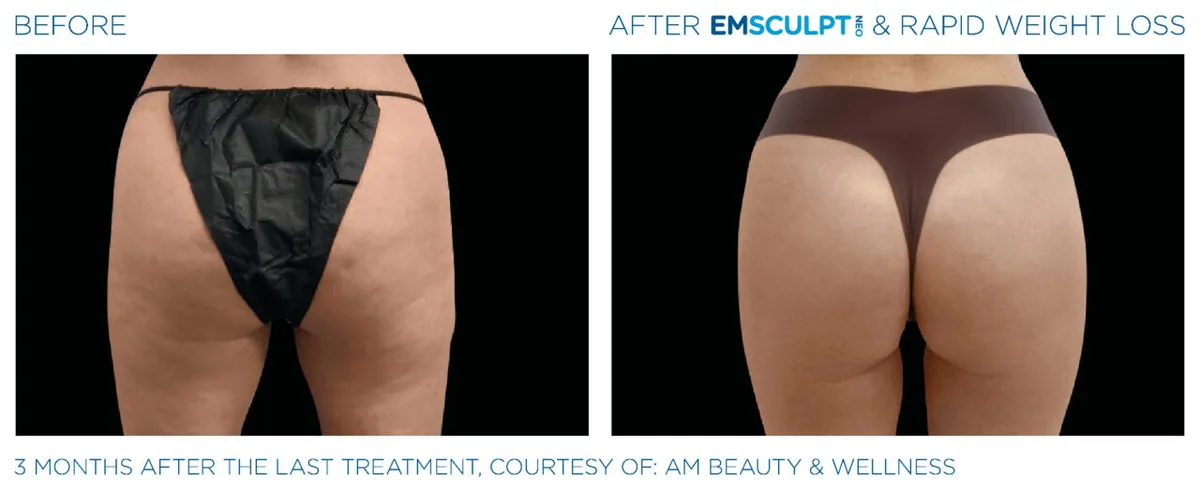 EMSCULPT NEO before and after, female buttocks