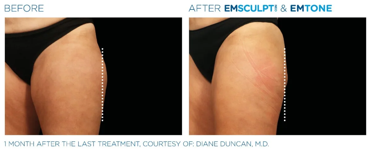 EMSCULPT NEO before and after, female outer thighs