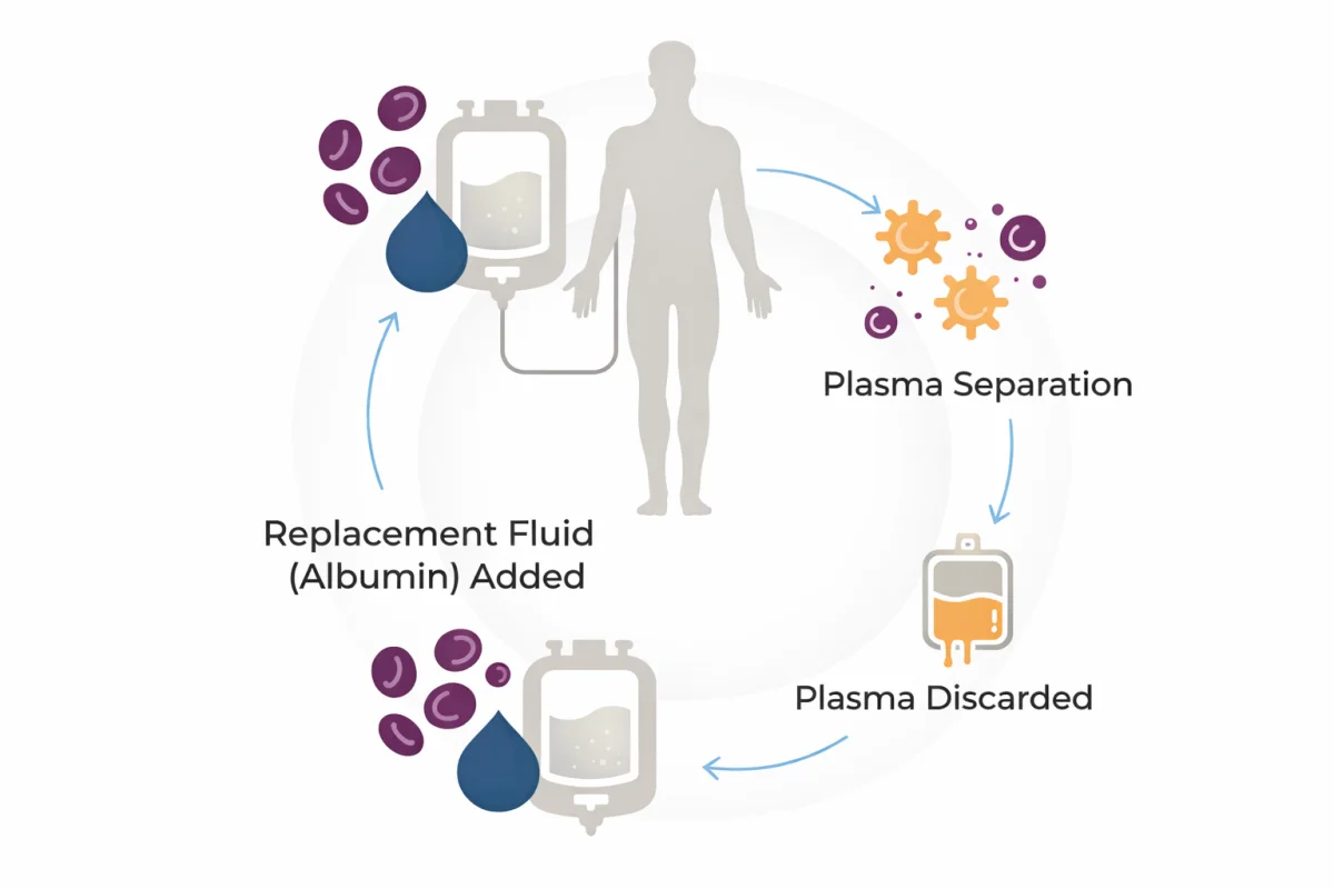 Diagram of the therapeutic plasma exchange process: blood is drawn and separated, plasma is discarded, replacement albumin fluid is added, and blood cells are returned to the body.